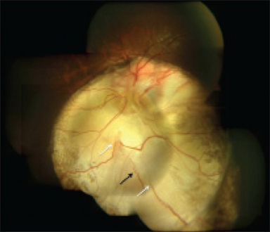 Type 5 disc involvement in coloboma of choroid-left eye
