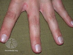 One hand affected in externally caused contact dermatitis