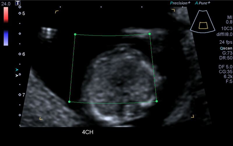 File:1st trimester nuchal-morphology ultrasound (Radiopaedia 44706-48477 Heart views cine with colour 58).jpg