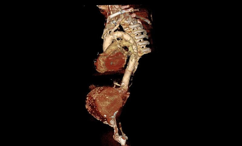 File:Abdominal aortic aneurysm- extremely large, ruptured (Radiopaedia 19882-19921 3D 7).jpg
