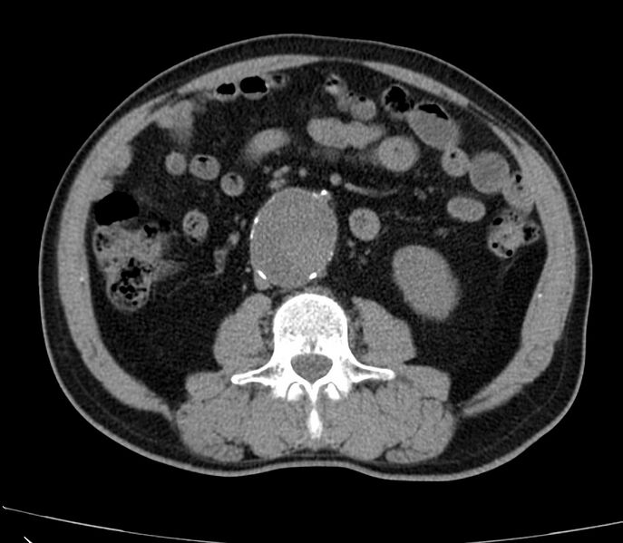 File:Abdominal aortic aneurysm (Radiopaedia 22421-22458 non-contrast 28).jpg