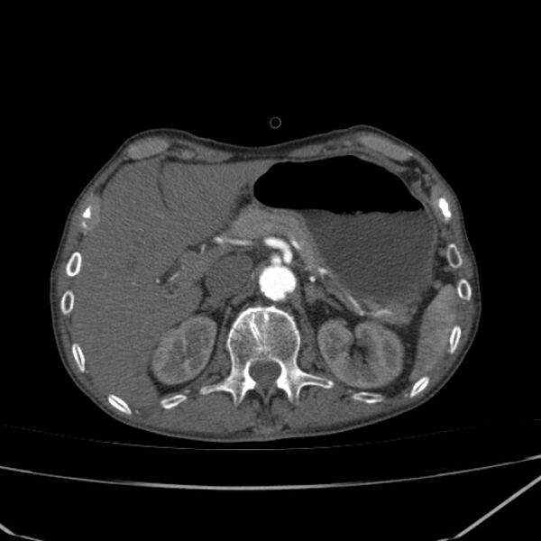 File:Abdominal aortic aneurysm (Radiopaedia 23703-23856 Axial C+ arterial phase 16).jpg