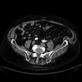 Abdominal aortic aneurysm (Radiopaedia 25855-26001 Axial C+ arterial phase 96).jpg