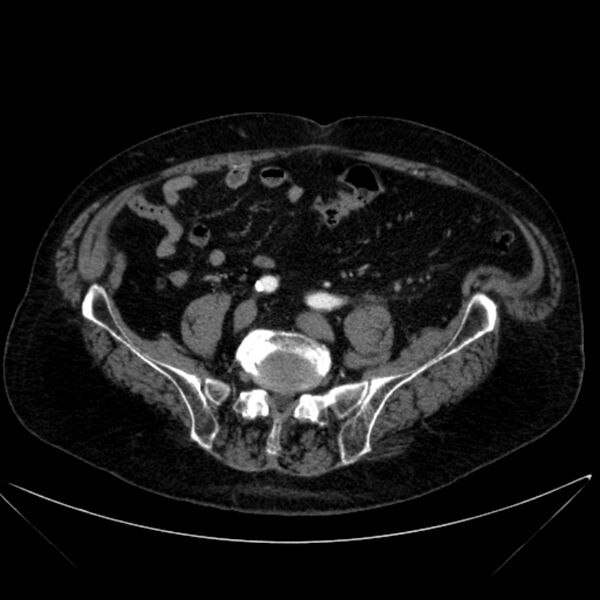 File:Abdominal aortic aneurysm (Radiopaedia 25855-26001 Axial C+ arterial phase 96).jpg