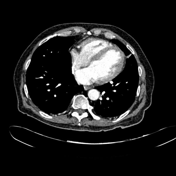 File:Abdominal aortic aneurysm (Radiopaedia 75131-86203 Axial C+ arterial phase 2).jpg