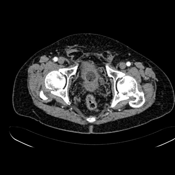 File:Abdominal aortic aneurysm (Radiopaedia 75131-86203 Axial C+ arterial phase 45).jpg