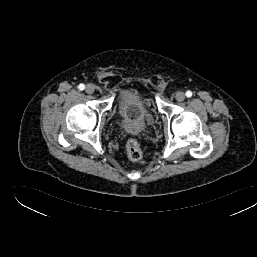 Abdominal aortic aneurysm (Radiopaedia 75131-86203 Axial C+ arterial phase 45).jpg