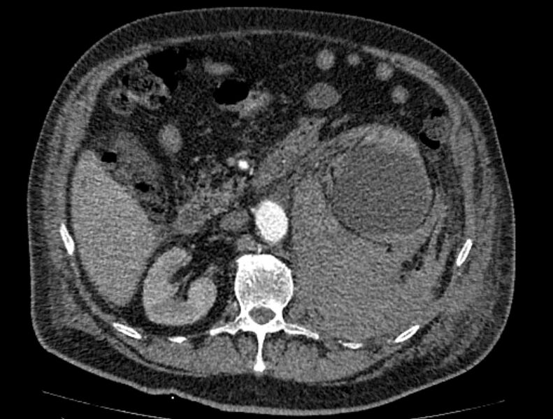 File:Abdominal aortic aneurysm rupture (Radiopaedia 54179-60362 Axial C+ arterial phase 29).jpg