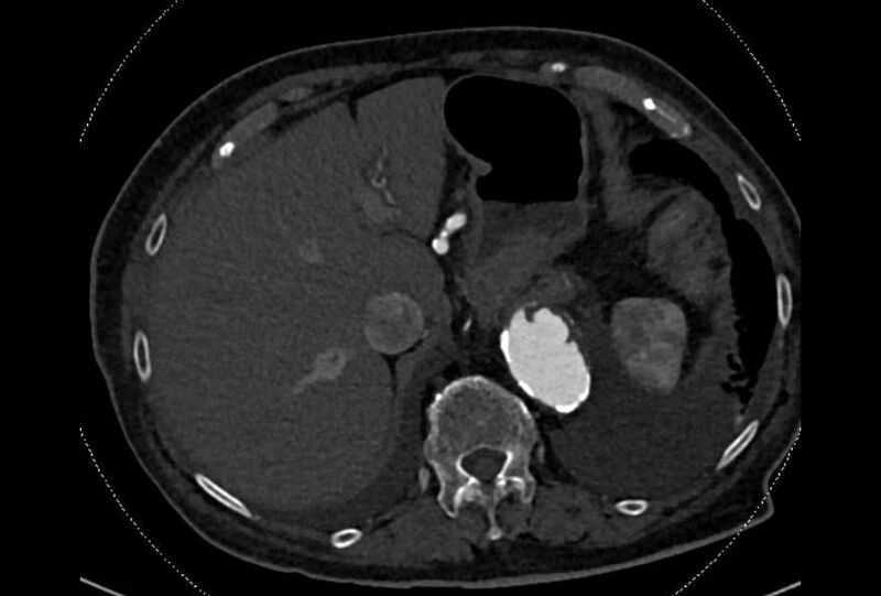 File:Abdominal aortic aneurysm with thrombus fissuration (Radiopaedia 73192-83919 Axial C+ arterial phase 16).jpg