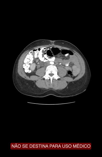 File:Abdominal desmoid tumor (Radiopaedia 44024-47540 Axial C+ arterial phase 18).jpg