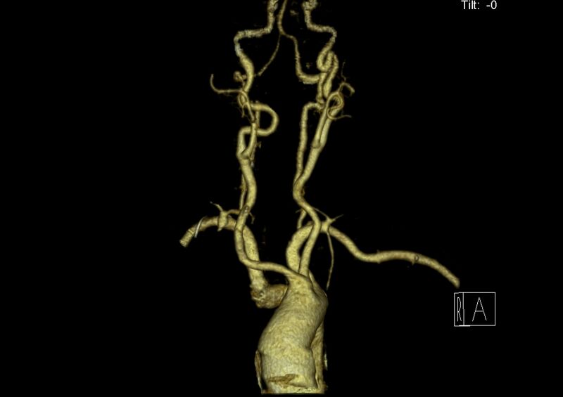 File:Aberrant right subclavian artery (Radiopaedia 19283-19294 3D reconstruction C+ arterial phase 5).jpg