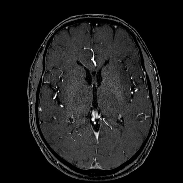 File:Accessory middle cerebral artery (Radiopaedia 73114-83828 Axial MRA 105).jpg