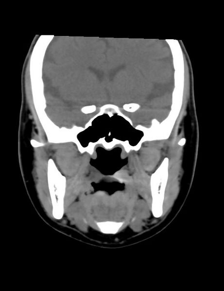 File:Accessory parotid glands (Radiopaedia 27289-27472 Coronal non-contrast 12).jpg