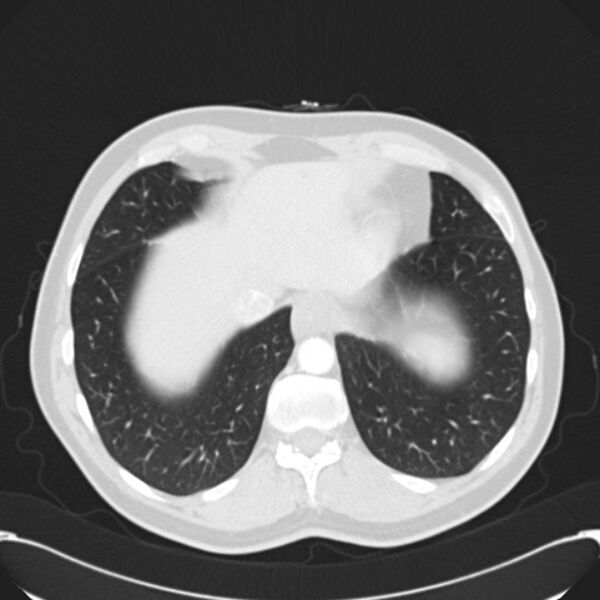 File:Achalasia (Radiopaedia 24937-25206 Axial lung window 28).jpg