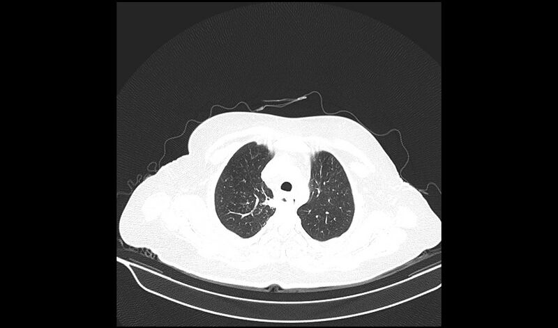File:Acquired tracheo-esophageal fistula (Radiopaedia 51356-57103 Axial lung window 9).jpg