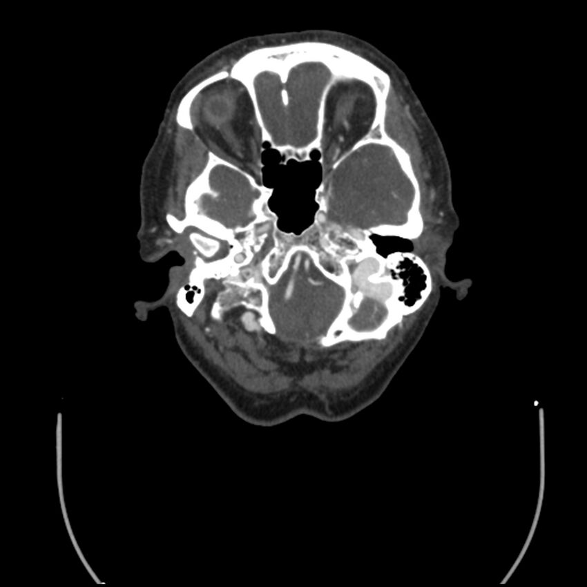 Acute M1 occlusion with ischemic penumbra (CT perfusion) (Radiopaedia 71897-82344 Axial C+ arterial phase thins 131).jpg