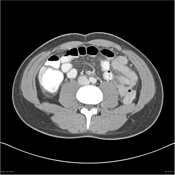 File:Acute appendicitis (Radiopaedia 25364-25615 B 36).jpg