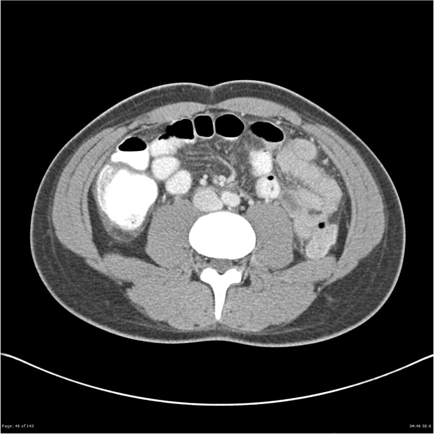 Acute appendicitis (Radiopaedia 25364-25615 B 36).jpg
