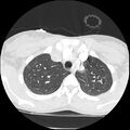 Acute chest syndrome - sickle cell disease (Radiopaedia 42375-45499 Axial lung window 43).jpg