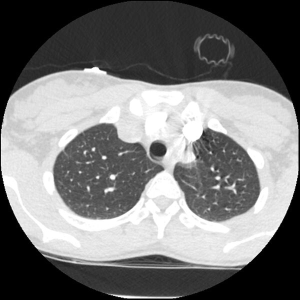 File:Acute chest syndrome - sickle cell disease (Radiopaedia 42375-45499 Axial lung window 43).jpg