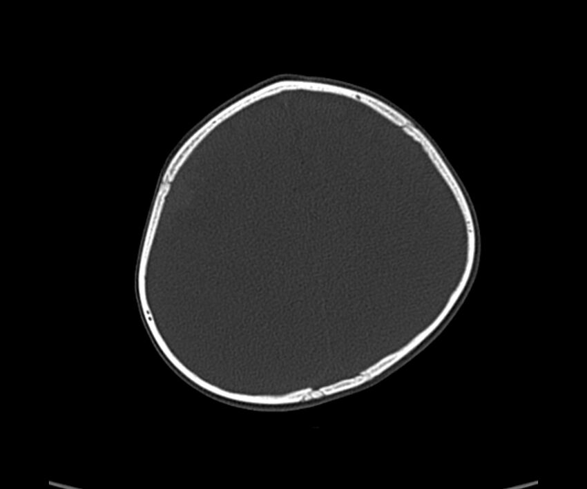Acute hemorrhagic contusion (Radiopaedia 63660-72336 Axial bone window 51).jpg
