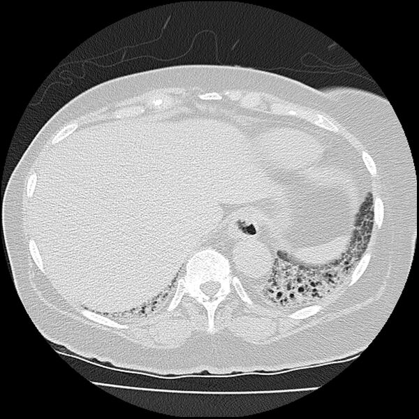 File:Acute interstitial pneumonitis (Radiopaedia 45404-49452 Axial lung window 78).jpg