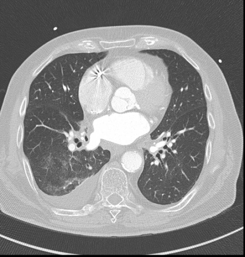 Acute myocardial infarction (Radiopaedia 23413-23481 lung window 38).jpg