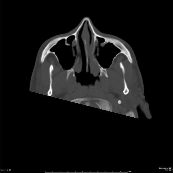 File:Acute otomastoiditis (Radiopaedia 28276-28512 Axial bone window 1).jpg