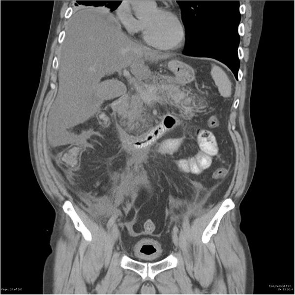 File:Acute pancreatitis (Radiopaedia 19135-19116 Coronal non-contrast 18).jpg