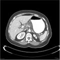Acute pancreatitis (Radiopaedia 19136-19117 Axial C+ portal venous phase 7).jpg