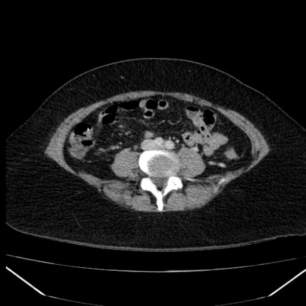 File:Acute pancreatitis - Balthazar C (Radiopaedia 26569-26714 Axial C+ portal venous phase 63).jpg