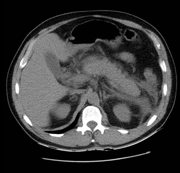 File:Acute pancreatitis - Balthazar E (Radiopaedia 23080-23110 Axial non-contrast 21).jpg