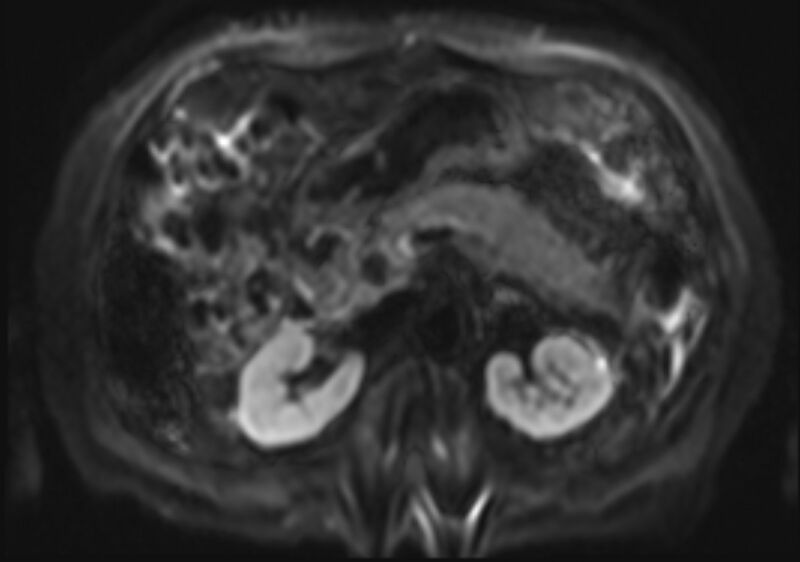 File:Acute portal vein thrombosis (Radiopaedia 73198-83925 Axial DWI 18).jpg