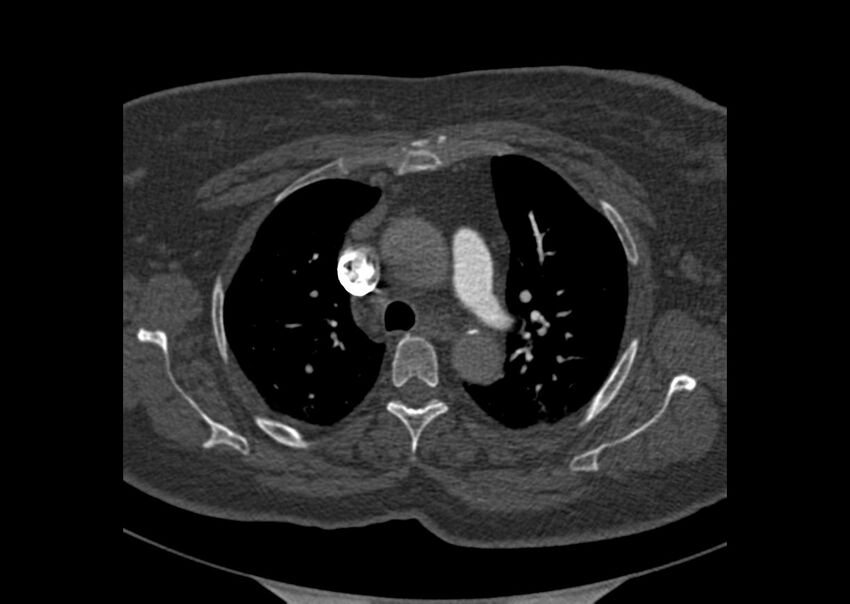 Acute pulmonary embolism (Radiopaedia 29938-30466 Axial C+ CTPA 14).jpg