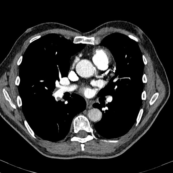 File:Acute pulmonary embolism (Radiopaedia 81677-95570 Axial C+ CTPA 53).jpg