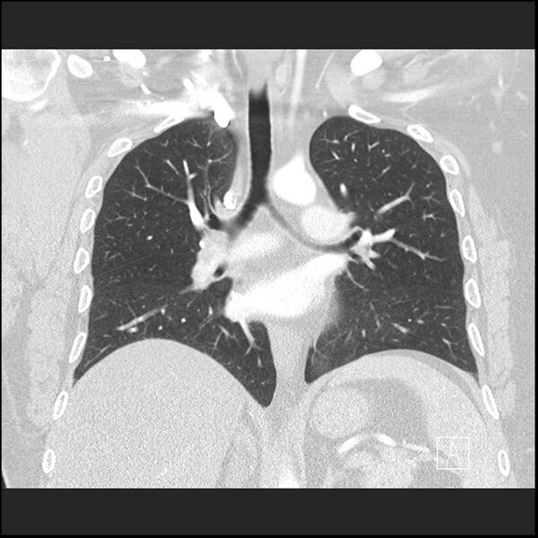 File:Acute pulmonary embolism with pulmonary infarct (Radiopaedia 73062-83768 Coronal lung window 42).jpg