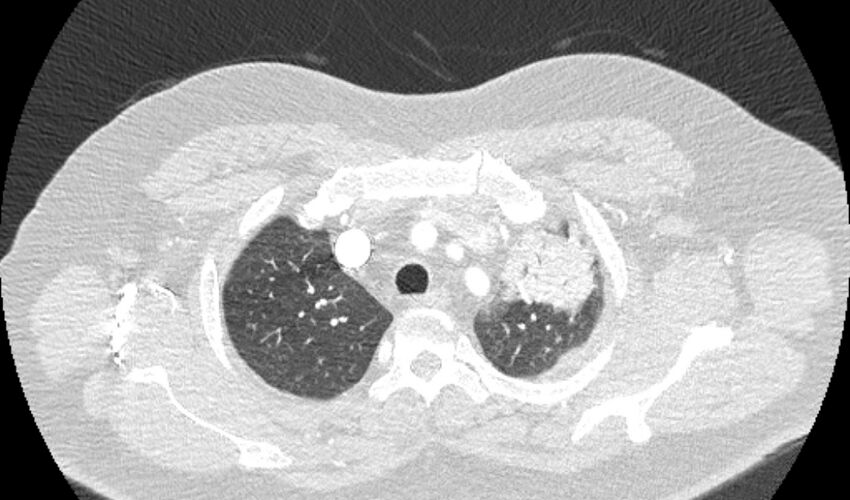 Acute pulmonary embolism with pulmonary infarcts (Radiopaedia 77688-89908 Axial lung window 11).jpg