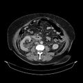 Acute pyelonephritis (Radiopaedia 25657-25837 Axial renal parenchymal phase 44).jpg