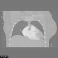 Acute reversible pulmonary hypertension and right heart failure from cocaine toxicity (Radiopaedia 49394-54517 Coronal C+ CTPA 8).jpg
