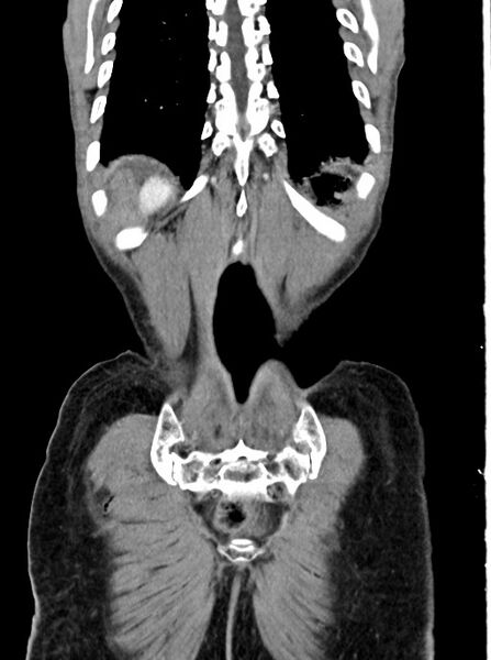 File:Acute small bowel (ileal) volvulus (Radiopaedia 71740-82139 Coronal C+ portal venous phase 100).jpg