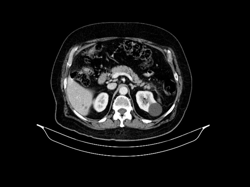 File:Adenocarcinoma of pancreas with hepatic metastasis (Radiopaedia 64332-73122 Axial C+ portal venous phase 35).jpg