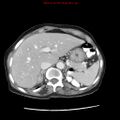 Adenocarcinoma of the colon (Radiopaedia 8191-9039 Axial liver window 17).jpg