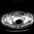 Adenocarcinoma of the colon (Radiopaedia 8191-9039 Axial renal excretory phase 58).jpg