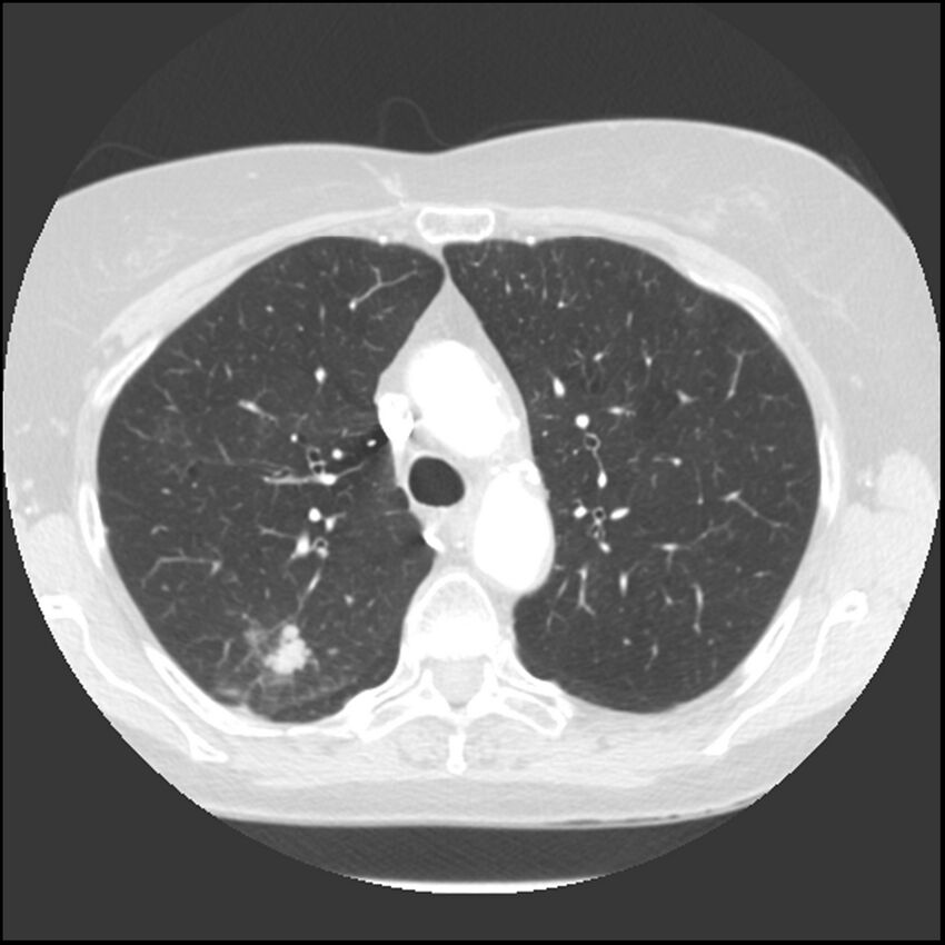 Adenocarcinoma of the lung (Radiopaedia 41015-43755 Axial lung window 38).jpg