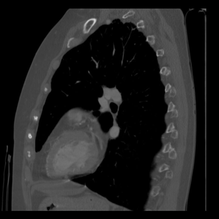 Adenocarcinoma of the lung (Radiopaedia 41015-43755 Sagittal bone window 67).jpg
