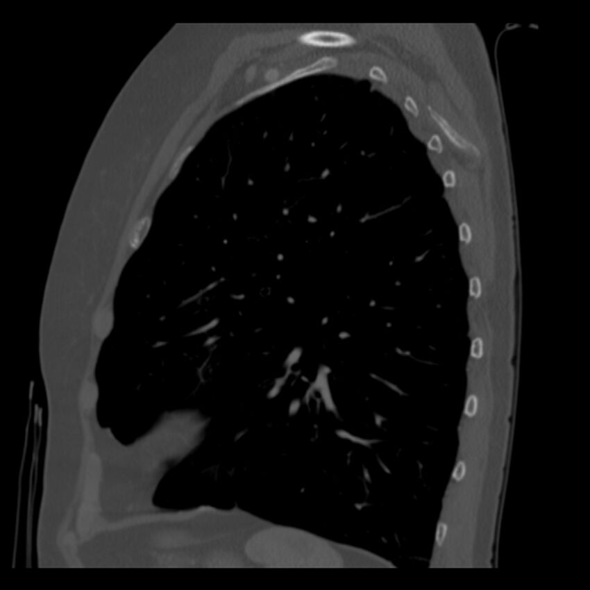Adenocarcinoma of the lung (Radiopaedia 41015-43755 Sagittal bone window 79).jpg