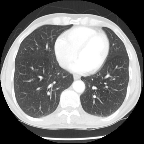 File:Adenocarcinoma of the lung - micropapillary predominant (Radiopaedia 42446-45563 Axial lung window 51).jpg