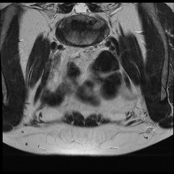 File:Adenoma malignum of the cervix (Radiopaedia 24460-24765 Coronal T2 2).jpg
