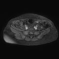 Adenomyoma of the uterus (huge) (Radiopaedia 9870-10438 Axial T1 C+ fat sat 26).jpg