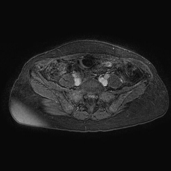 File:Adenomyoma of the uterus (huge) (Radiopaedia 9870-10438 Axial T1 C+ fat sat 26).jpg